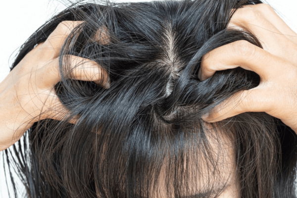 Une personne se gratte la tête à cause des poux