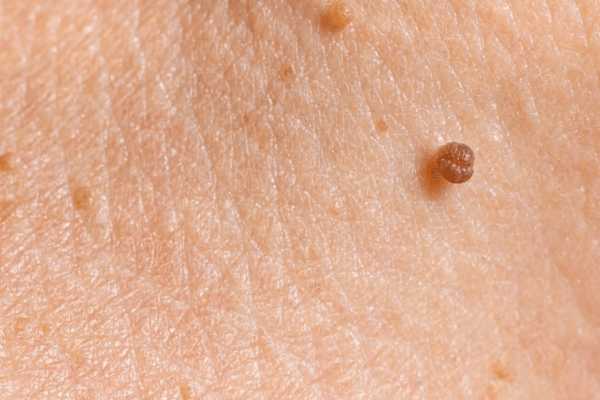 Verrue séborrhéique