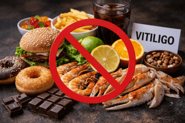 Vitiligo : quels aliments éviter pour ne pas aggraver la dépigmentation ?