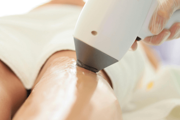 épilation laser avis