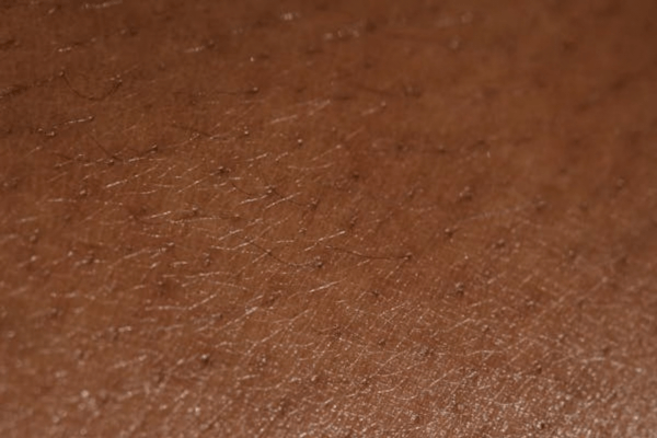 épilation laser sur peau noire