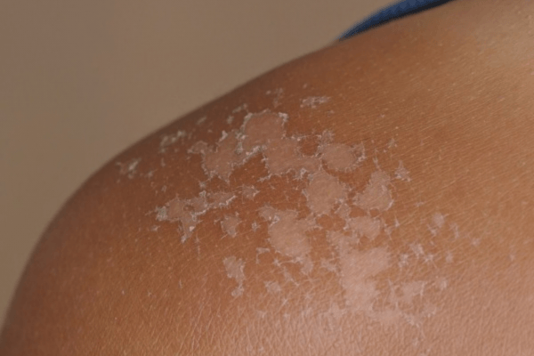 Masque LED et coup de soleil