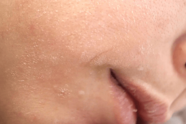 Masque LED et peau sèche