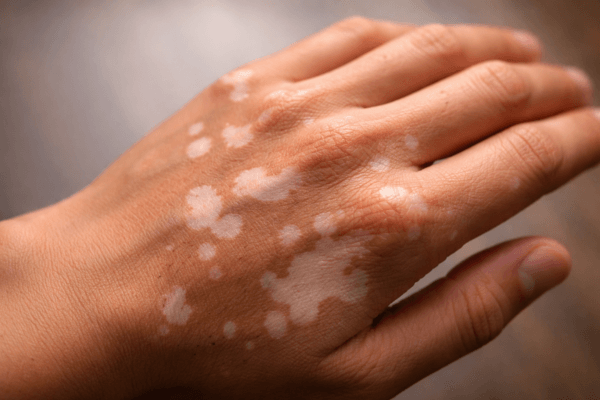 Vitiligo : les premiers signes à reconnaître (et ce qu’ils indiquent vraiment)