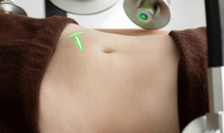 Cryolipolyse du ventre