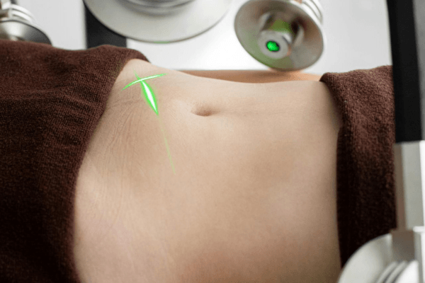 Cryolipolyse du ventre : ce que la technique fait vraiment (et pour qui elle est faite)