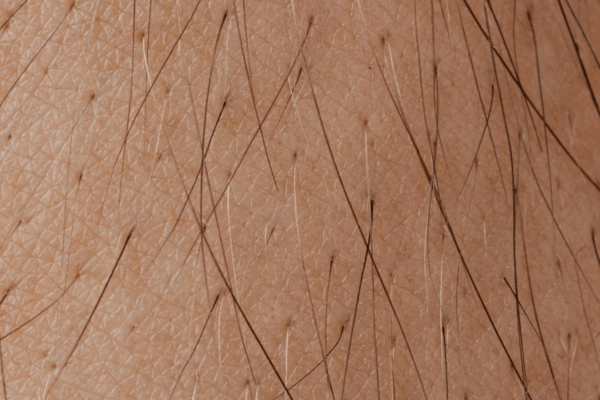 Repousse paradoxale après épilation laser : pourquoi ça arrive et comment y remédier