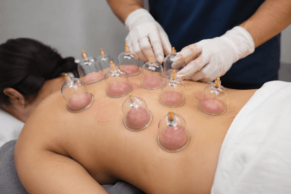 Cupping therapy : tout comprendre sur cette technique, ce qu’elle soigne et si elle est faite pour vous