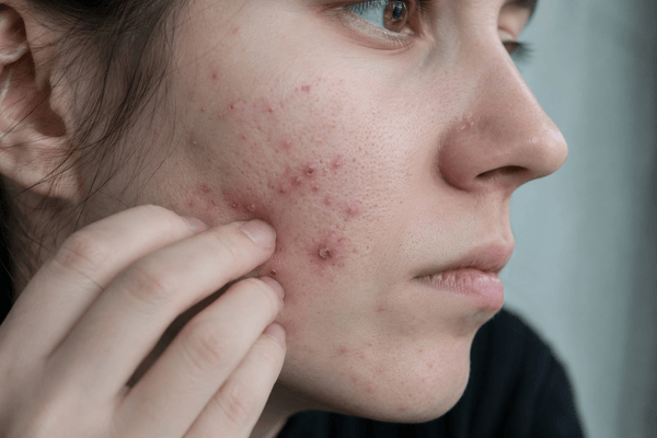 Dermatillomanie et autisme : stimming, TOC ou trouble à part entière ?