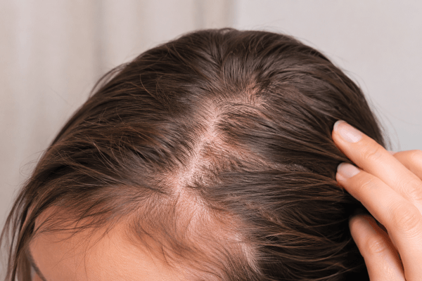 Dermatillomanie du cuir chevelu : comprendre ce grattage compulsif qui vous ronge de l’intérieur
