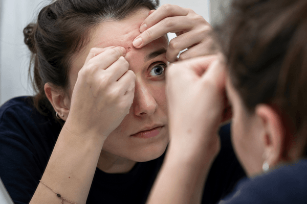 Dermatillomanie : comprendre ce trouble et trouver des solutions concrètes